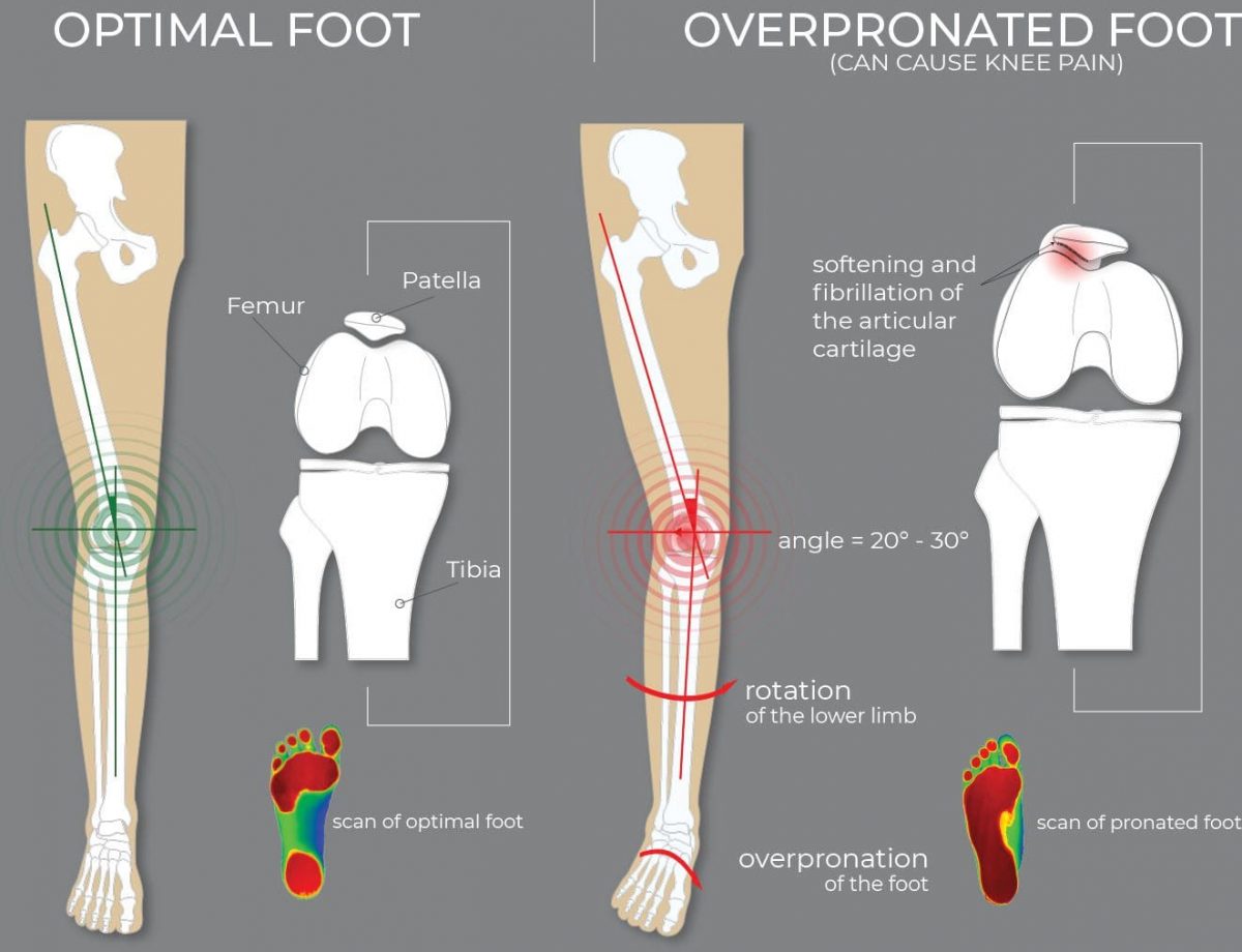 Dealing with Overpronation: Effective Strategies [Video]